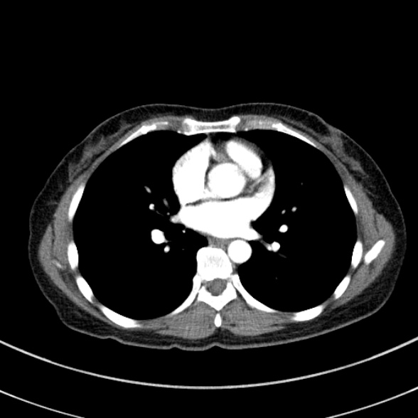 Adenocystic carcinoma of the trachea (Radiopaedia 47677-52525 Axial C+ arterial phase 55).jpg