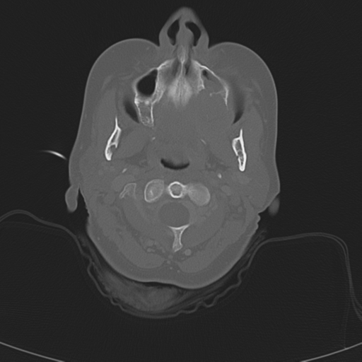 File:Adenoid cystic tumor of palate (Radiopaedia 46980-51518 Axial bone window 28).png