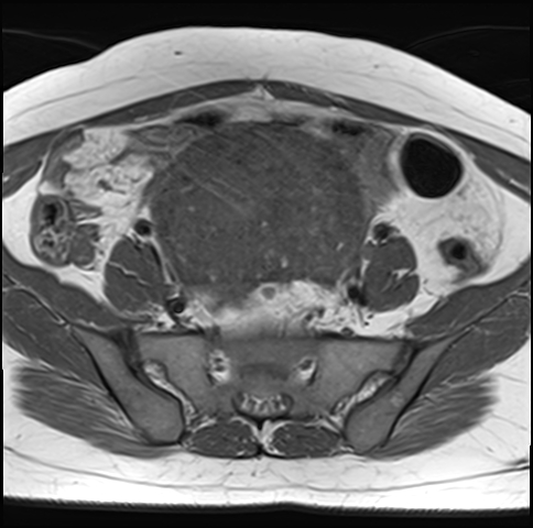 File:Adenomyosis - ovarian endometriomas (Radiopaedia 67031-76350 Axial T1 8).jpg