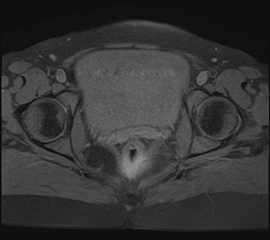 File:Adenomyosis - ovarian endometriomas (Radiopaedia 67031-76350 Axial T1 fat sat 21).jpg