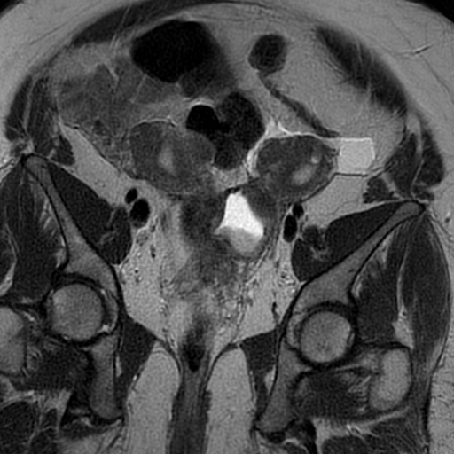 File:Adenomyosis within a didelphys uterus (Radiopaedia 70175-80215 Coronal T2 17).jpg
