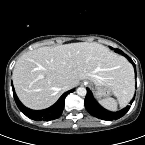 Adhesional small bowel obstruction (Radiopaedia 48397-53305 Axial C+ portal venous phase 8).jpg