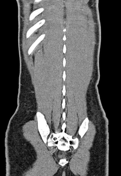 File:Adhesional small bowel obstruction (Radiopaedia 52107-57980 Coronal C+ portal venous phase 73).jpg