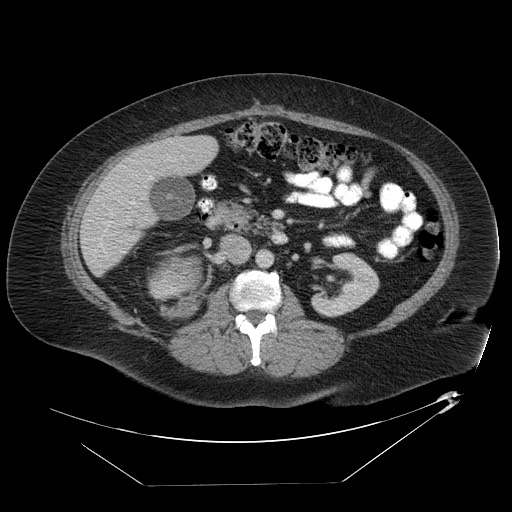 Adrenal angiosarcoma (Radiopaedia 81081-94671 Axial C+ portal venous phase 36).jpg