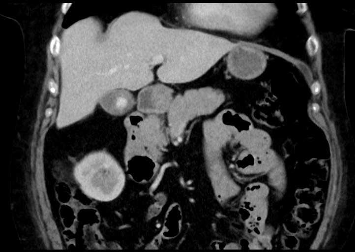 Adrenal cortical carcinoma (Radiopaedia 64017-72769 Coronal C+ portal venous phase 18).jpg
