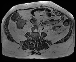 File:Adrenal cortical carcinoma (Radiopaedia 64017-72770 Axial T1 out-of-phase 59).jpg