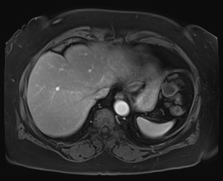 Adrenal cortical carcinoma (Radiopaedia 64017-72770 I 10).jpg