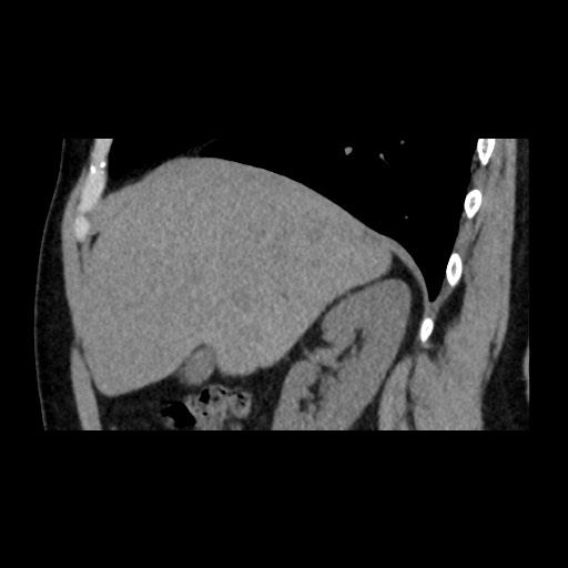 Adrenal gland trauma (Radiopaedia 81351-95079 Sagittal non-contrast 31).jpg