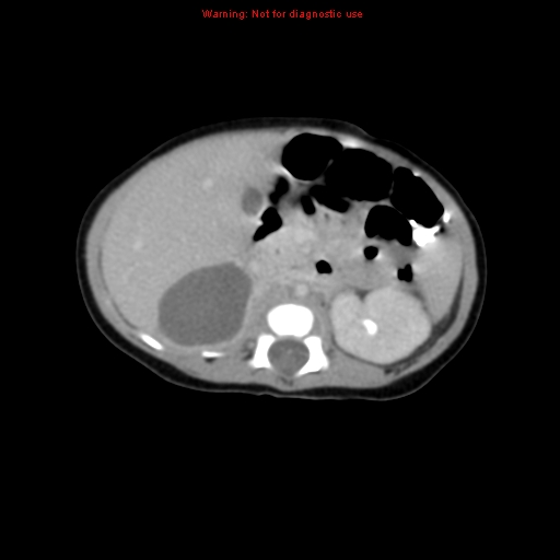 File:Adrenal hemorrhage (Radiopaedia 9390-10077 Axial C+ portal venous phase 9).jpg