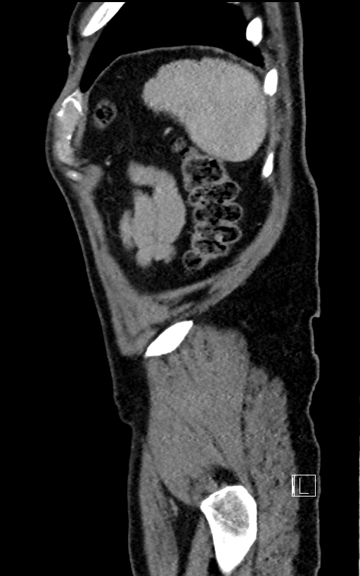 Adrenal lymphoma (Radiopaedia 73730-84529 Sagittal C+ portal venous phase 101).jpg