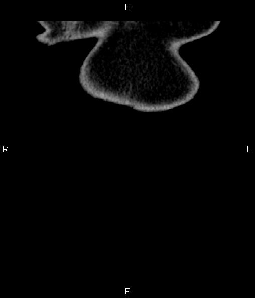 Adrenal myelolipoma (Radiopaedia 82742-96986 Coronal renal cortical phase 1).jpg