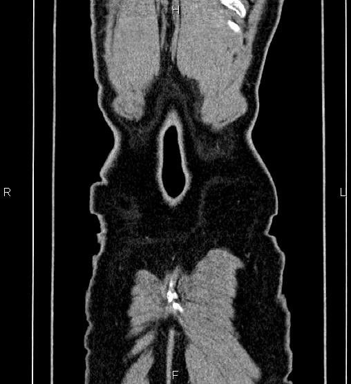 Adrenal myelolipoma (Radiopaedia 87794-104246 Coronal renal cortical phase 68).jpg