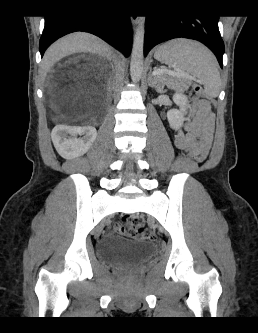 Adrenal myelolipoma - bilateral (Radiopaedia 74805-85810 Coronal C+ portal venous phase 127).jpg