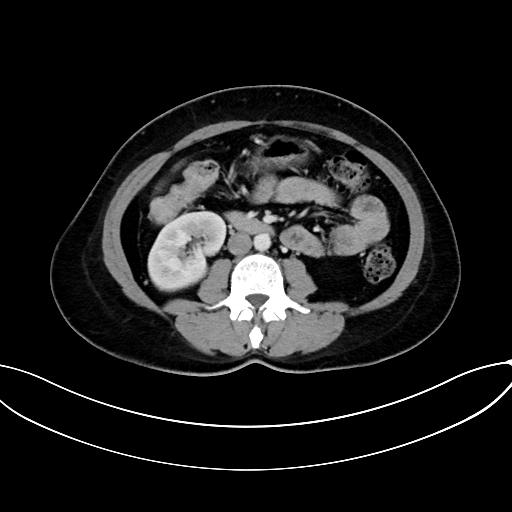 Adrenocortical carcinoma (Radiopaedia 87281-103569 Axial C+ portal venous phase 45).jpg