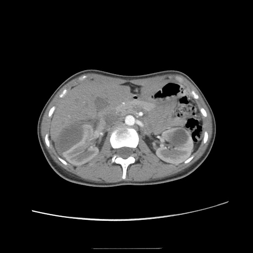 Adult polycystic kidney disease (Radiopaedia 48845-53876 Axial renal cortical phase 21).jpg