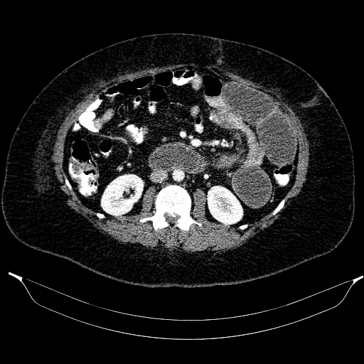 File:Afferent loop syndrome - secondary to incarcerated trocar site hernia (Radiopaedia 82959-97305 Axial C+ portal venous phase 111).jpg