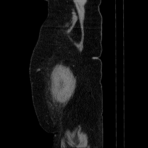 File:Afferent loop syndrome - secondary to incarcerated trocar site hernia (Radiopaedia 82959-97305 Sagittal C+ portal venous phase 3).jpg