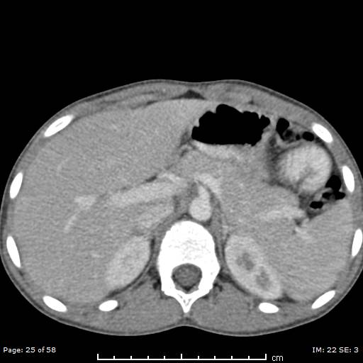 File:Agenesis of the gallbladder (Radiopaedia 55454-61905 B 25).jpg