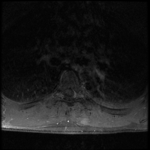 File:Aggressive vertebral hemangioma (Radiopaedia 39937-42404 Axial T1 C+ fat sat 26).png