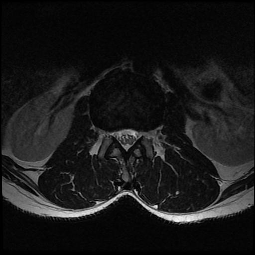 File:Aggressive vertebral hemangioma with pathological fracture (Radiopaedia 69528-79411 Axial T2 11).jpg