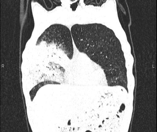 Air bronchogram in pneumonia (Radiopaedia 85719-101512 Coronal lung window 12).jpg