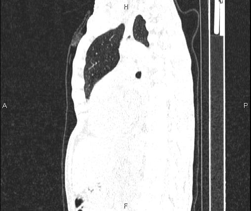 Air bronchogram in pneumonia (Radiopaedia 85719-101512 Sagittal lung window 56).jpg
