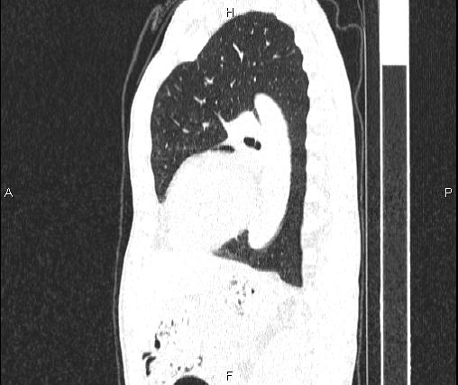 Air bronchogram in pneumonia (Radiopaedia 85719-101512 Sagittal lung window 63).jpg