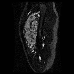 Alveolar soft part sarcoma (Radiopaedia 64501-73678 D 93).jpg