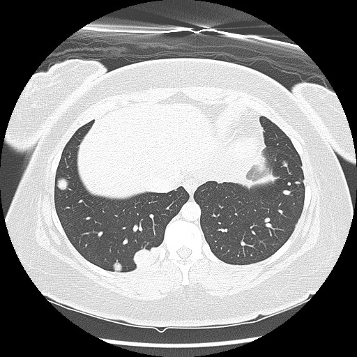 Alveolar soft part sarcoma - right leg (Radiopaedia 59432-67091 Axial lung window 90).jpg
