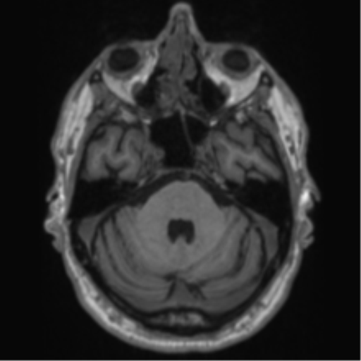 Alzheimer's disease- with Gerstmann syndrome and dressing apraxia (Radiopaedia 54882-61150 Axial T1 19).png