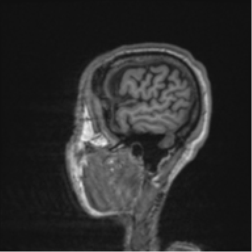 File:Alzheimer's disease- with apraxia (Radiopaedia 54763-61011 Sagittal T1 7).png