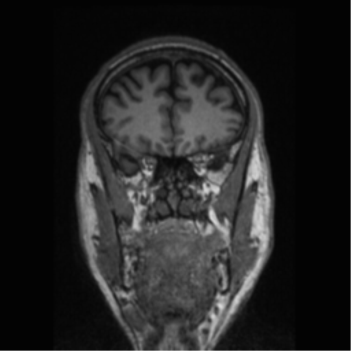 Alzheimer disease - probable (Radiopaedia 35334-36837 Coronal T1 66).png