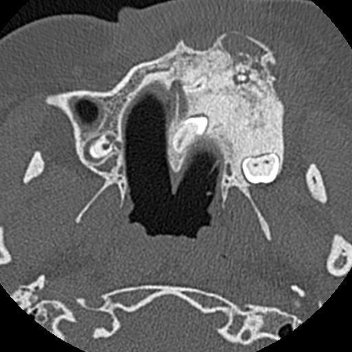 File:Ameloblastic fibro-odontoma (Radiopaedia 18843-18780 C 32).jpg