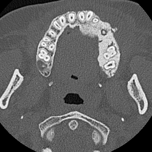 Ameloblastic fibro-odontoma (Radiopaedia 18843-18780 C 45).jpg
