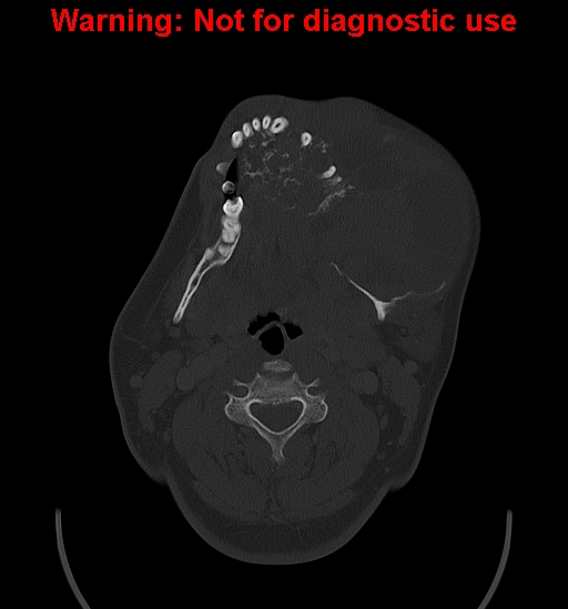 Ameloblastoma (Radiopaedia 33126-34164 Axial bone window 15).jpg