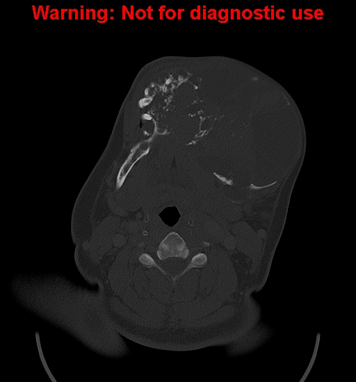 Ameloblastoma (Radiopaedia 33126-34164 Axial bone window 18).jpg