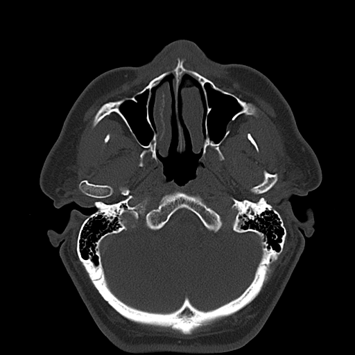 Ameloblastoma (Radiopaedia 38520-40623 Axial bone window 16).png