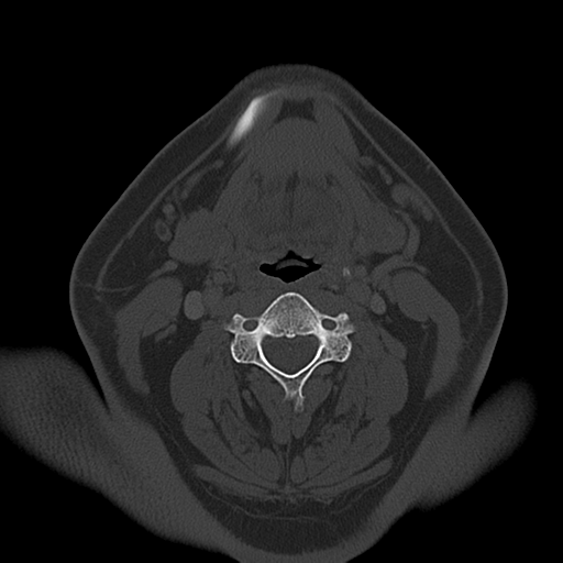 Ameloblastoma (Radiopaedia 38520-40623 Axial bone window 39).png