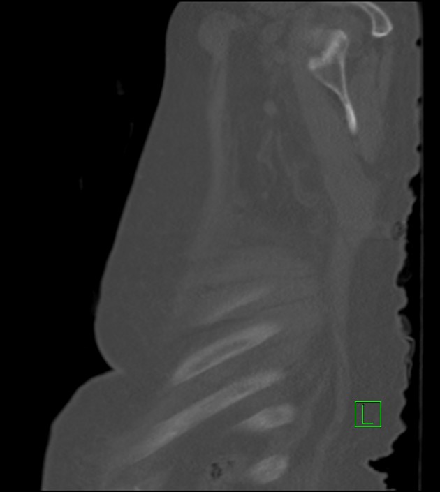 Amiodarone deposition in the liver (Radiopaedia 77587-89780 Sagittal bone window 14).jpg