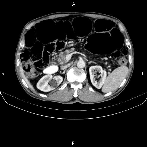 Ampullary adenocarcinoma (Radiopaedia 86093-102032 A 21).jpg