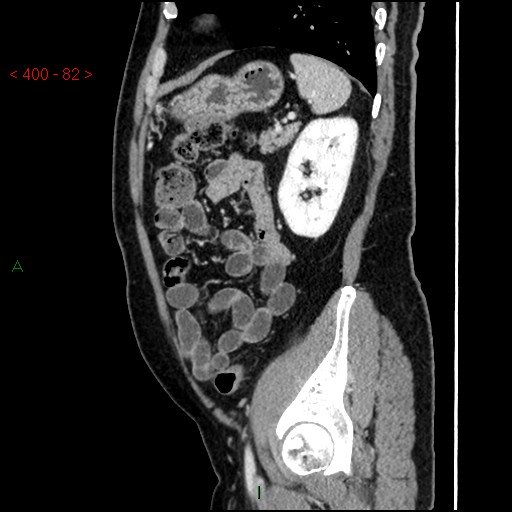 Ampullary carcinoma (Radiopaedia 56396-63056 D 81).jpg