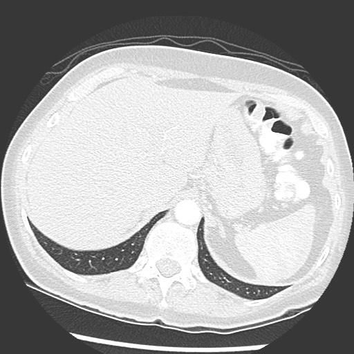 File:Amyloidosis - bronchial and diffuse nodular pulmonary involvement (Radiopaedia 60156-67745 Axial lung window 80).jpg
