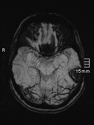 File:Amyotrophic lateral sclerosis (Radiopaedia 70821-81017 Axial SWI minIP 15).jpg