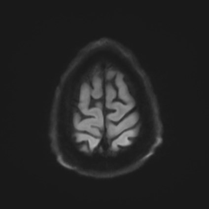 File:Amyotrophic lateral sclerosis (Radiopaedia 87352-103658 Axial DWI 54).jpg