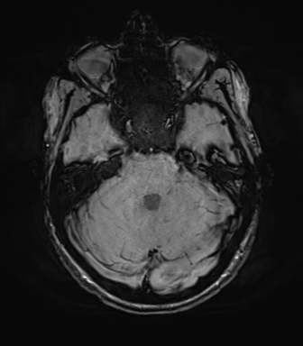 File:Anaplastic astrocytoma IDH mutant (Radiopaedia 50046-55341 Axial SWI 27).png