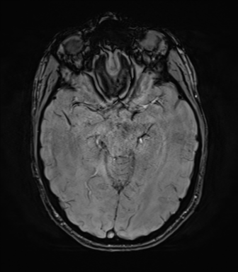 File:Anaplastic astrocytoma IDH mutant (Radiopaedia 50046-55341 Axial SWI 37).png