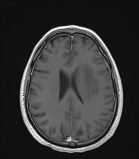 Anaplastic astrocytoma IDH wild-type (Radiopaedia 49984-55273 Axial T1 C+ 38).png