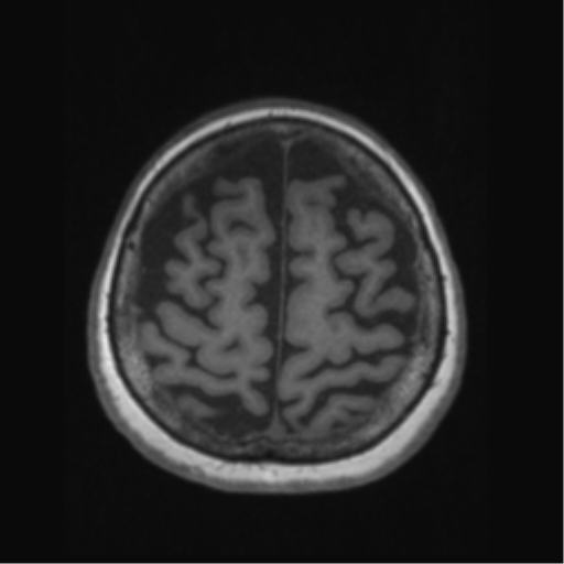 Anaplastic astrocytoma IDH wild-type (pseudoprogression) (Radiopaedia 42209-45276 Axial T1 122).png