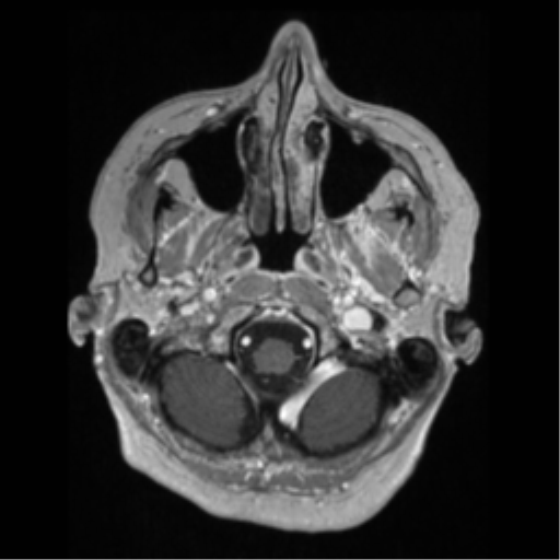 File:Anaplastic astrocytoma IDH wild-type (pseudoprogression) (Radiopaedia 42209-45276 Axial T1 C+ 22).png
