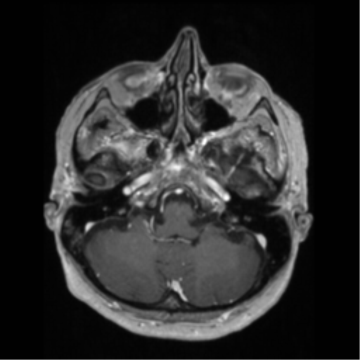 File:Anaplastic astrocytoma IDH wild-type (pseudoprogression) (Radiopaedia 42209-45276 Axial T1 C+ 37).png